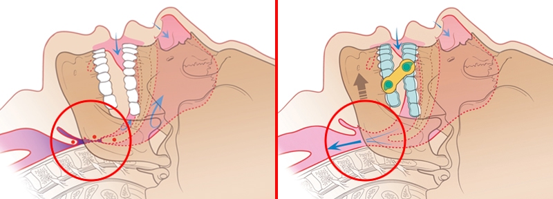 Graphic of an obstructed airway with and without a snore guard.
