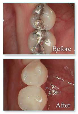 Tooth Colored Filling Before And After