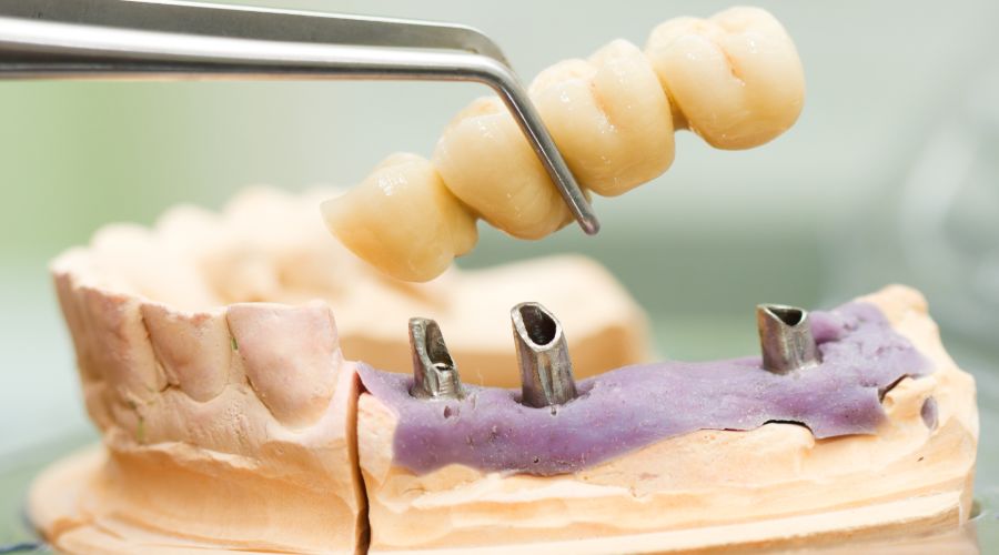 Dental Bridge