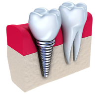 Dental Implants