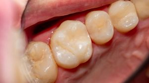 Dental Onlay