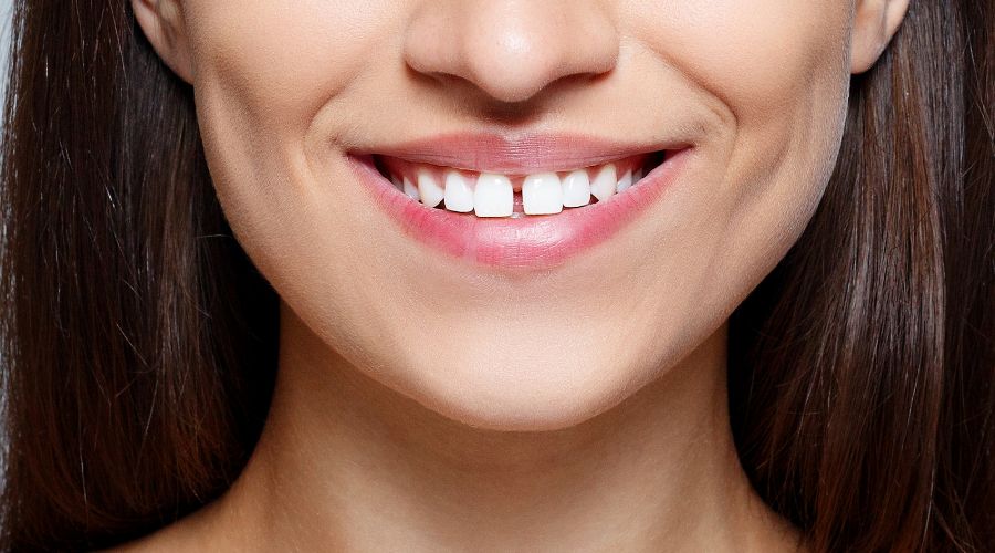 Tooth Gap