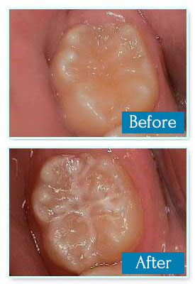 Tooth Sealant Before And After