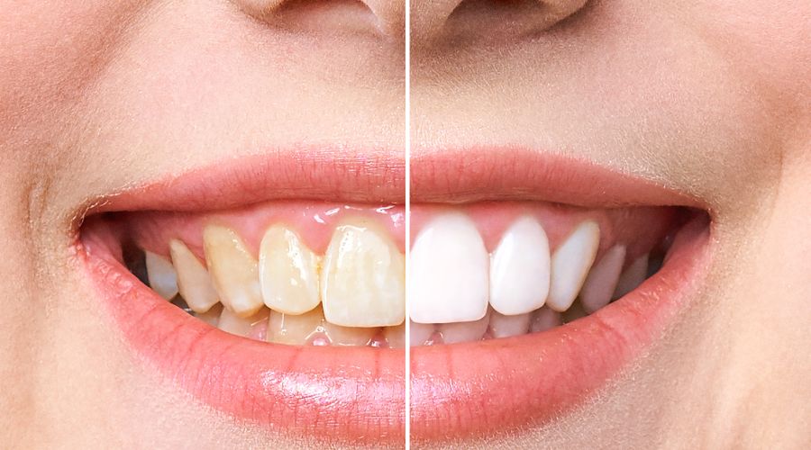 Tooth Stains