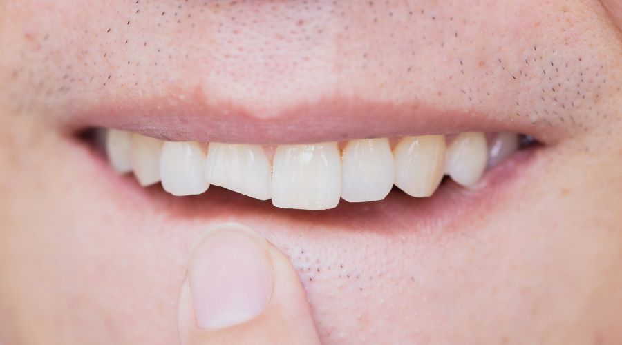 Tooth Wear