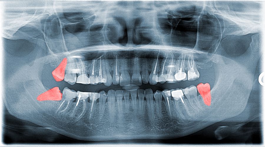 Wisdom Teeth